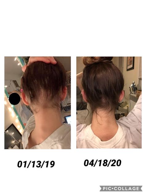 My 4 Month Rogaine Experience! (23f .
